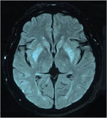 Case report: Extrapontine myelinolysis combined with flupentixol- and melitracen-induced dysphagia